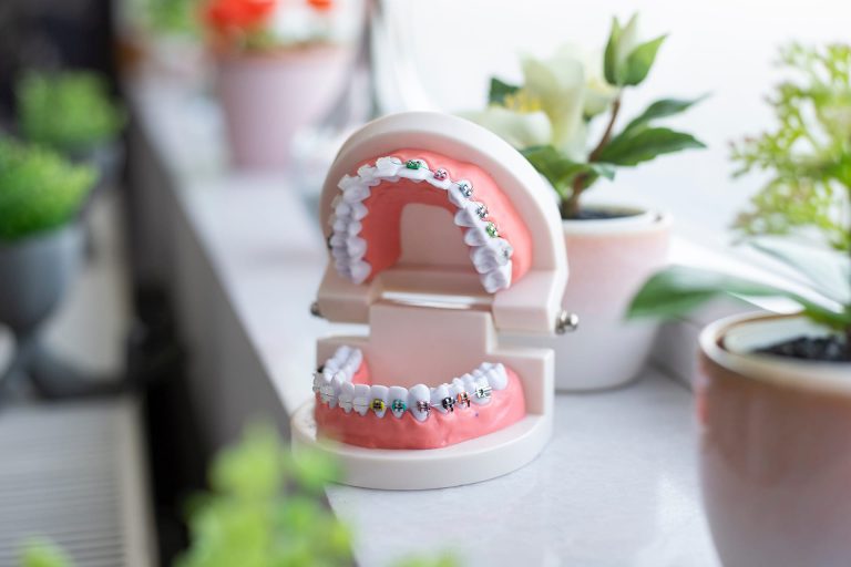 Bọc Răng Sứ Bao Nhiêu Tiền?